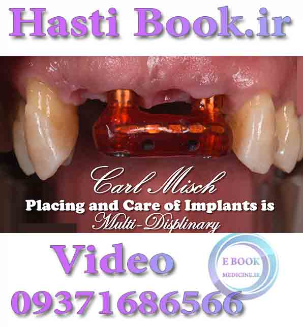 فیلم  Placing and Care of Implants is Multi-Disciplinary - Carl Misch (Videos)