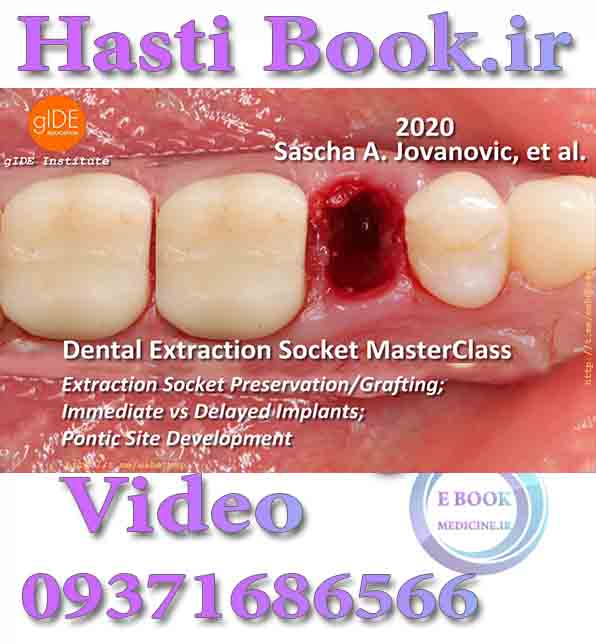 دانلودفیلم gIDE Dental Extraction Socket PreservationGrafting; Immediate vs Delayed Implants; Pontic Site Development 2020 (video) .